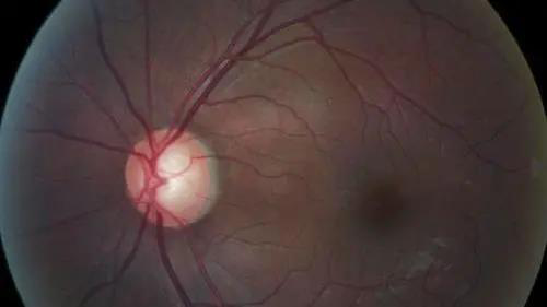 青光眼的克星来袭，助力患者远离视力的“窃贼”