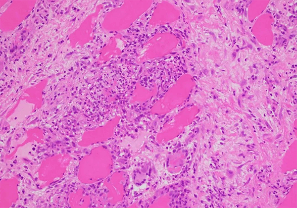 【BB贝博助力】医治结节病的KBMAB-16获FDA核准临床